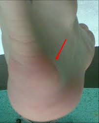 Haglundse Exostose Rijnland Orthopaedie