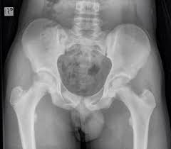 Seniors who have osteoporosis are at a much higher risk of. Pelvic Avulsion Injuries