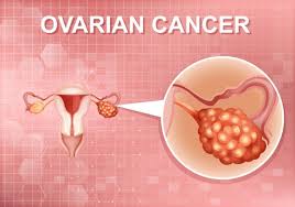 The early warning signs of ovarian cancer are often extremely subtle, which is why most women aren't diagnosed until the disease has advanced to stage iii or iv. Premium Vector Ovarian Cancer Awareness With Female Symbol