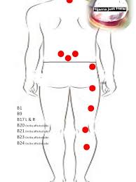 Lowerbackpain In 2020 Cupping Therapy Acupressure Treatment Acupressure Therapy