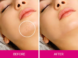 Our clients agree that the results are definitely worth the investment. Laser Hair Removal Costs Treatments Colaz Clinics