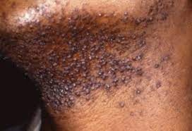 Wet the area around the ingrown hair with warm water. Ingrowing Hair Faciem Dermatology Clinic