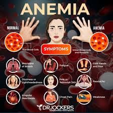 Image result for Anemia