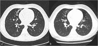 Cystic fibrosis is an inherited disease characterized by the buildup of thick, sticky mucus that can damage many of the body's organs. Ultra Low Dose Chest Ct In Adult Patients With Cystic Fibrosis Using A Third Generation Dual Source Ct Scanner Springerlink