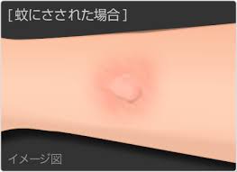 Maybe you would like to learn more about one of these? è™«ã•ã•ã‚Œã®ç—‡çŠ¶ åŽŸå›  ãã™ã‚Šã¨å¥åº·ã®æƒ…å ±å±€
