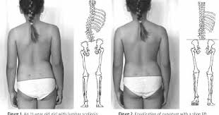 Image result for Functional Leg Length Discrepancy