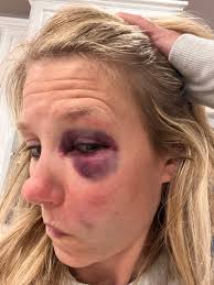 You should see the other guy! Ok here's the story: “Mom can you pitch to me  before practice?” “Sure bud!” And this is how it ended with Mom (me) taking  a line