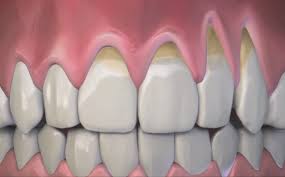 Retraccion De Encias Clinica Dental Ceballos