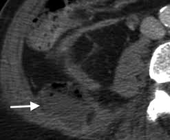 Save a life by knowing the signs and the most effective interventions. Fournier Gangrene Role Of Imaging Radiographics