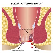 Image result for Hemorrhoid