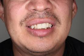 All-On-4 Dental Implants