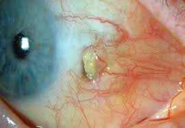 Image result for lesion sclera