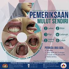 Kanser lisan juga boleh muncul sebagai patch putih atau merah pada gusi, tonsil, atau lapisan mulut. National Cancer Society Of Malaysia Penang Branch Pengesanan Kanser Mulut Melalui Pemeriksaan Mulut Sendiri