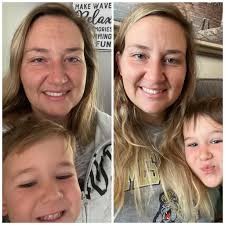 Breast implant removal symptoms improvement