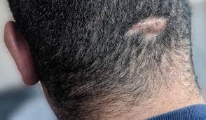 Pimples on scalp causes hair loss pimples on scalp causes hair loss by several common conditions. Scarring Hair Loss Wikiwand