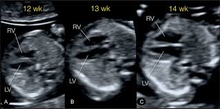 Fetal Cardiac Examination In Early Gestation Obgyn Key Simon robben, rick van rijn and robin smithuis. fetal cardiac examination in early