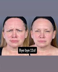 Botox and Skin Vive leaving this client looking softened and refreshed 😍💉  #botox #medspa #aesthetics #tox #saintjohns #sjc #jax #aestheticinjector  #nurseinjector #NP