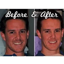 Pin On Davis Engert Dentistry Before And After
