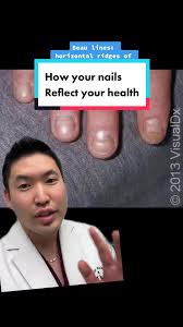 Image result for Beau lines feet