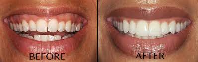 In these instances, proper dental care and treatment is needed to first solve the issue and then help reduce the gummy smile. Why Botox Is A Fast And Easy Way To Fix A Gummy Smile Without Surgery Newbeauty