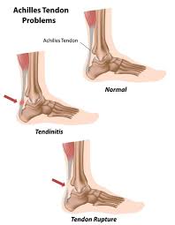 Tendons are situated between bone and muscles and are bright white in colour. Achilles Tendon Diagram Extend Orthopedics
