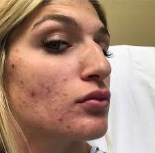An ingrown hair occurs when a shaved or tweezed hair grows back into the skin. Ingrown Facial Hair Why It Happens Remedies To Remove It