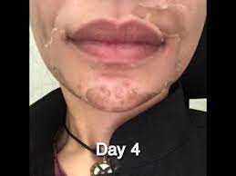 مراحل التقشير الكيميائي الأزرق Chemical Peel Tca Youtube