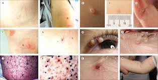 But most cases get better you can spread molluscum contagiosum: References In Molluscum Contagiosum Virus Infection The Lancet Infectious Diseases