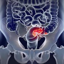 Câncer de intestino: 2 em cada 3 brasileiros não conhecem exame preventivo