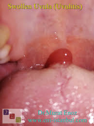 Image result for Uvulitis