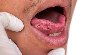 Image result for Puchýře na jazyku