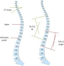1 doctor answer • 1 doctor weighed in suspicious densities overlying the right first anterior rib, apicolordotic view is suggested. Specific Sagittal Alignment Patterns Are Already Present In Mild Adolescent Idiopathic Scoliosis Springerlink