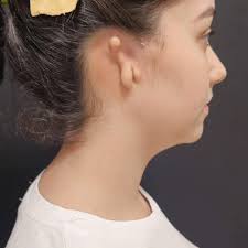 Kilis'te bir ilk Ameliyat daha Türkiye'de ender kliniklerde  gerçekleştirilen mikrotia operasyonu Op. Dr. Fatih Dipçin ve ekibi  öncülüğünde Kilis Prof. Dr. Alaeddin Yavaşca Devlet Hastanesinde  gerçekleştirildi. Konu hakkında açıklama yapan Kilis Prof.