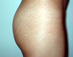 Sebabnya minyak jarak kaya akan vitamin e. Four Ways To Remove Stretch Marks From Your Skin