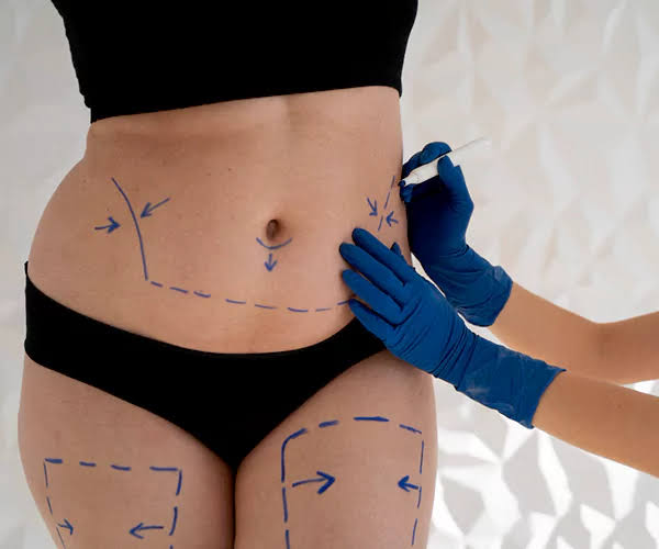 The cost of Liposuction in Dubai: Is it worth It? - La Vie Clinic