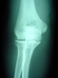 Bone tumors in dogs and cats can arise in any bone of the body including the long bones within limbs, toes, spinal vertebrae, ribs and the skull. Osteoarthritis Of The Elbow Orthoinfo Aaos