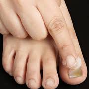 Furthermore, the mild acidic nature of this ingredient may help. Causes And Home Remedies For Nail Fungus Among Most Common Infections