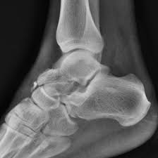 Image result for Talus Fracture