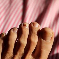 Image result for Yellow nail syndrome feet