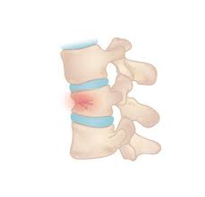Image result for Spinal Trauma