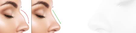 My nose was already broken when i had this done, which makes it much easier. Rhinoplasty Nose Surgery Reshaping Nose Job Surgery In Essex
