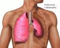 Pneumotorace - Scienza e salute