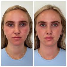 We don't aim to change your look; we simply want to change the way the  light reflects off the face. In the before picture, notice how the  nasolabial fat pad captures shadows.