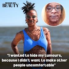 Alex Lee was diagnosed with Neurofibromatosis when she was in middle  school. The tumours first developed across her chest and stomach, but  eventually spread all over her body, severely affecting Alex's confidence.