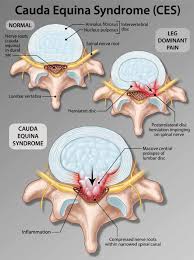 We did not find results for: Cauda Equina Syndrome Samarpan Physiotherapy Clinic Ahmedabad