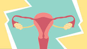 What are the symptoms of ovarian cancer? Ovarian Cancer Symptoms Stages And Treatment Health Com