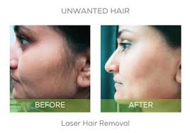 We offer a specialized holistic approach for skin, face, and body cosmetic solutions including injectables, microdermabrasion, laser treatments, . Laser Hair Removal Tri Valley Health Aesthetics Hair Removal Laser Hair Removal Laser