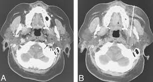 Image result for Paropsia