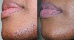 How To Stop Female Facial Hair Growth Using Diet And Nutrition Female Facial Hair Facial Hair Growth Ingrown Facial Hair