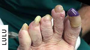 Tener las uñas largas no sólo es poco atractivo, pero también dice mucho acerca de cómo cuidar de ti mismo. Paso Anos Sin Cortarse Las Unas De Los Pies Youtube